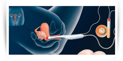 Pengambilan Telur di IVF: Bagaimana Telur Dikumpulkan?