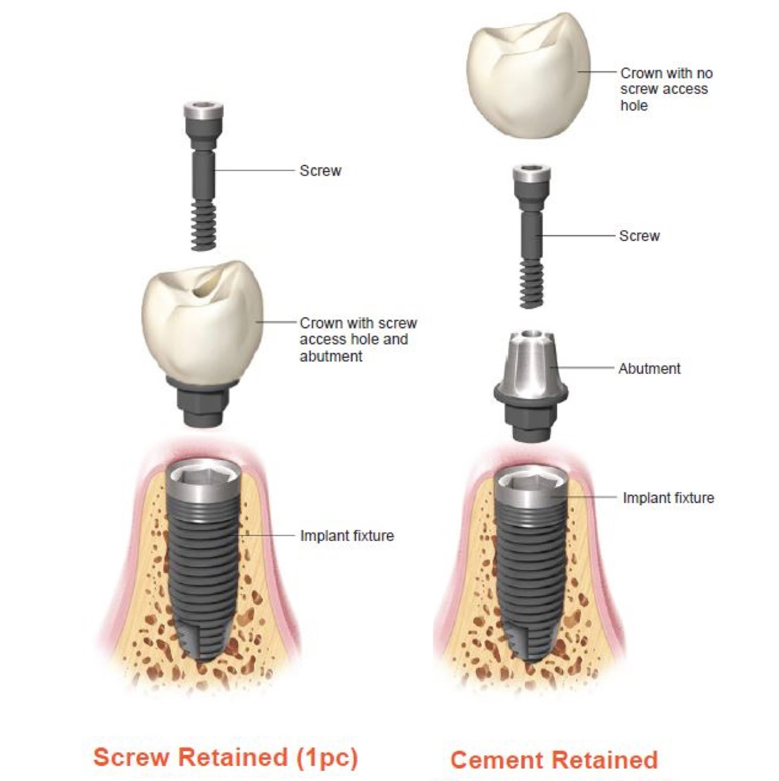 Cement vs screw Retained Abutment Cement vs screw Retained Abutment